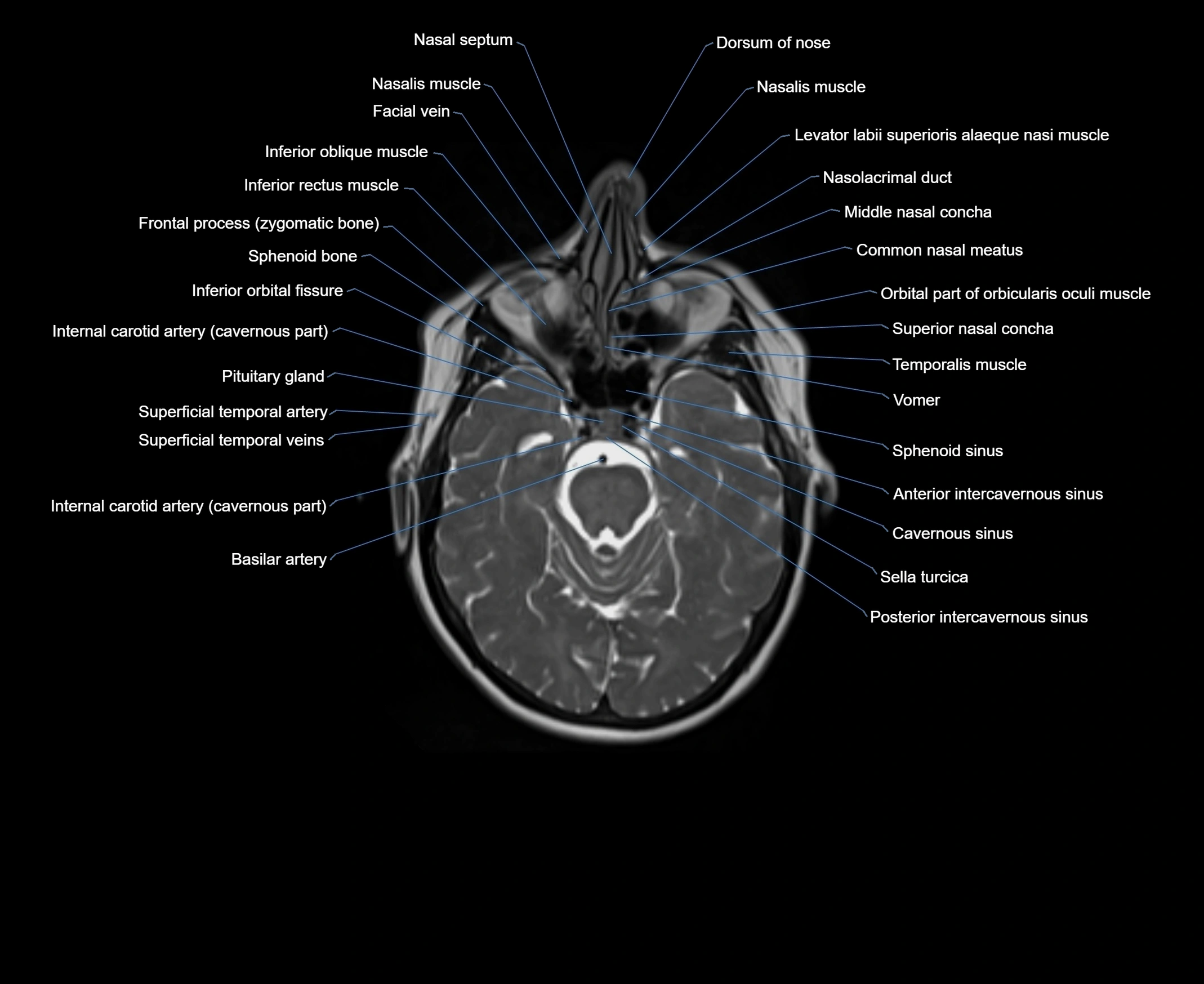 MRI Neck 3D labelled cross section anatomy axial 3t image-00001-00002.webp